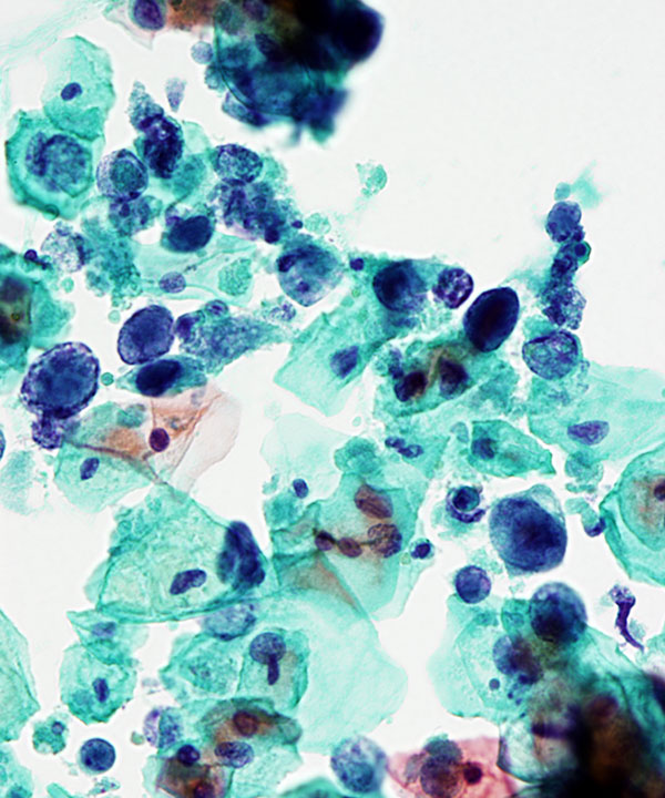 09 : Urine Polyoma Virus Infection