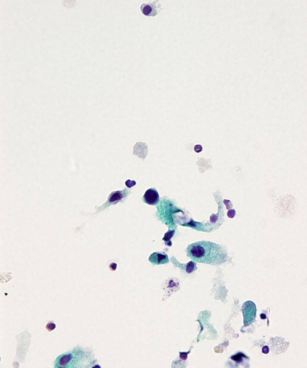 image showing 'Therapy Related Atypia'