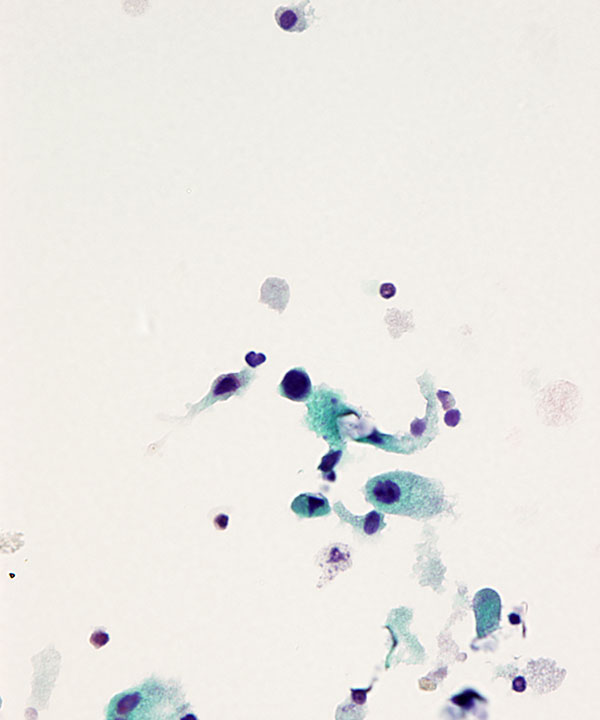 02 : Urine Therapy Related Atypia