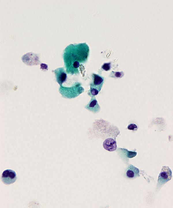 03 : Urine Therapy Related Atypia